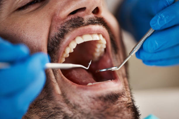 Best Emergency Dentist for Lost Fillings or Crowns in Swanton, OH